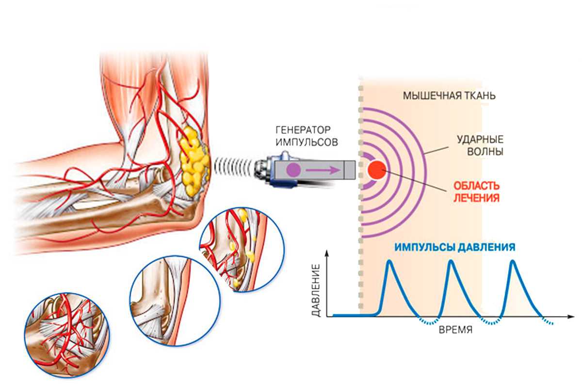 Сколько делать ударно волновую терапию